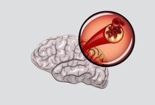 How to differentiate between types of stroke (ischemic and hemorrhagic)