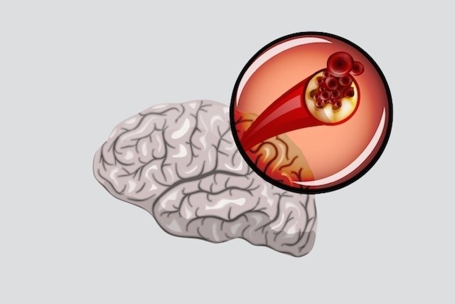 How to differentiate between types of stroke (ischemic and hemorrhagic)