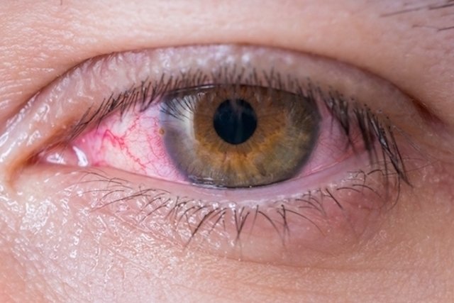 How to treat conjunctivitis: ointments, eye drops and necessary care