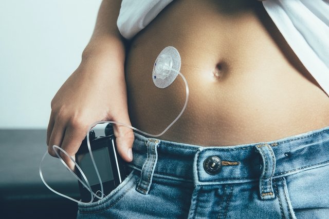 Insulin pump: how it works and when it is recommended