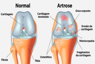 Is osteoarthritis curable?  What to do to treat