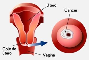 Main causes of cervical cancer (and how to prevent it)