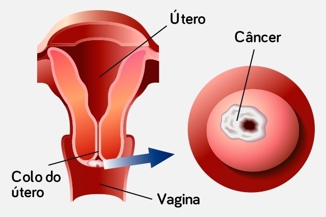 Main causes of cervical cancer (and how to prevent it)