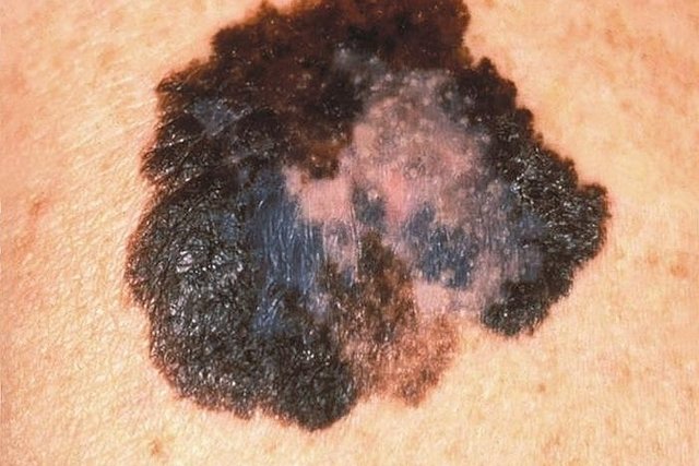 Melanoma: what it is, symptoms, causes, types and treatment