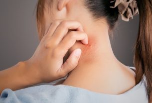 Nickel allergy: symptoms, causes and treatment