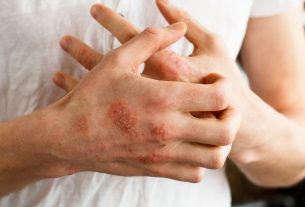 Nummular dermatitis: what it is, symptoms, causes and treatment