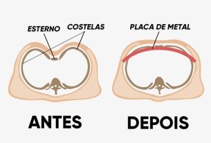 Peito escavado: o que é, sintomas, causas e tratamento