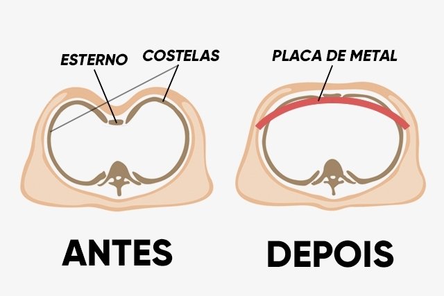 Peito escavado: o que é, sintomas, causas e tratamento