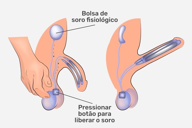 How the inflatable penile prosthesis works