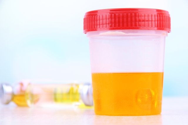 Protein in urine (proteinuria): what it can be, symptoms and treatment