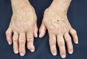 Psoriatic arthritis: what it is, symptoms, types and treatment