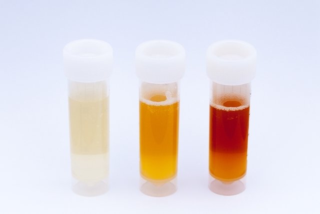 Red blood cells in the urine: what they mean and treatment