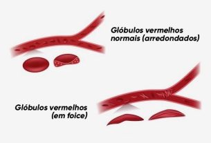 Sickle cell anemia: what it is, symptoms, causes and treatment