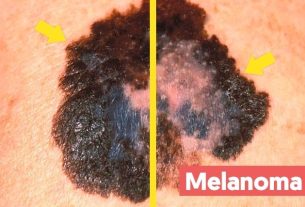 Signs and symptoms of melanoma on the skin (ABCD method)