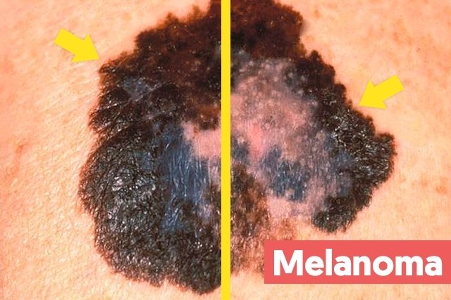 Signs and symptoms of melanoma on the skin (ABCD method)