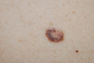 Skin cancer: what it is, symptoms, types and treatment