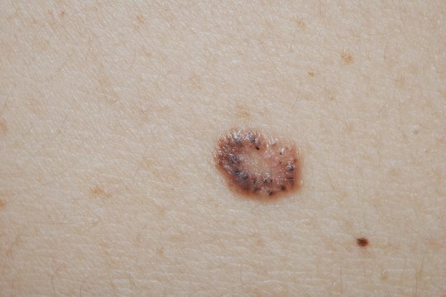 Skin cancer: what it is, symptoms, types and treatment