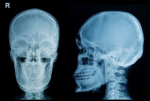 Skull fracture: what it is, symptoms and treatment