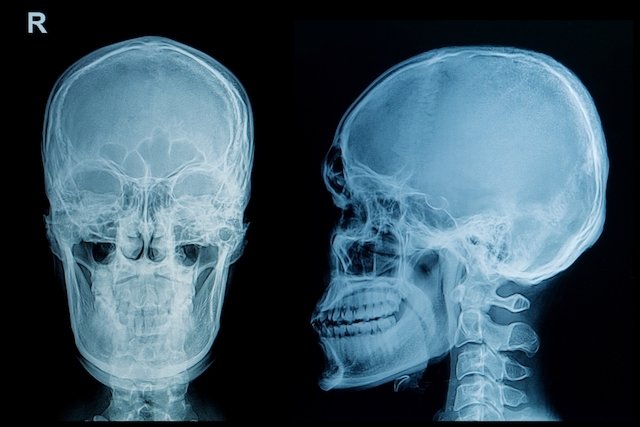 Skull fracture: what it is, symptoms and treatment