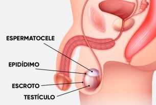 Spermatocele: what it is, symptoms, causes and treatment