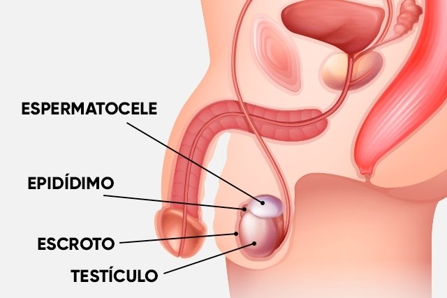 Spermatocele: what it is, symptoms, causes and treatment