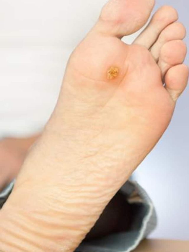 Suffering From Diabetic Foot Ulcers? Add These 10 Foods In Your Diet