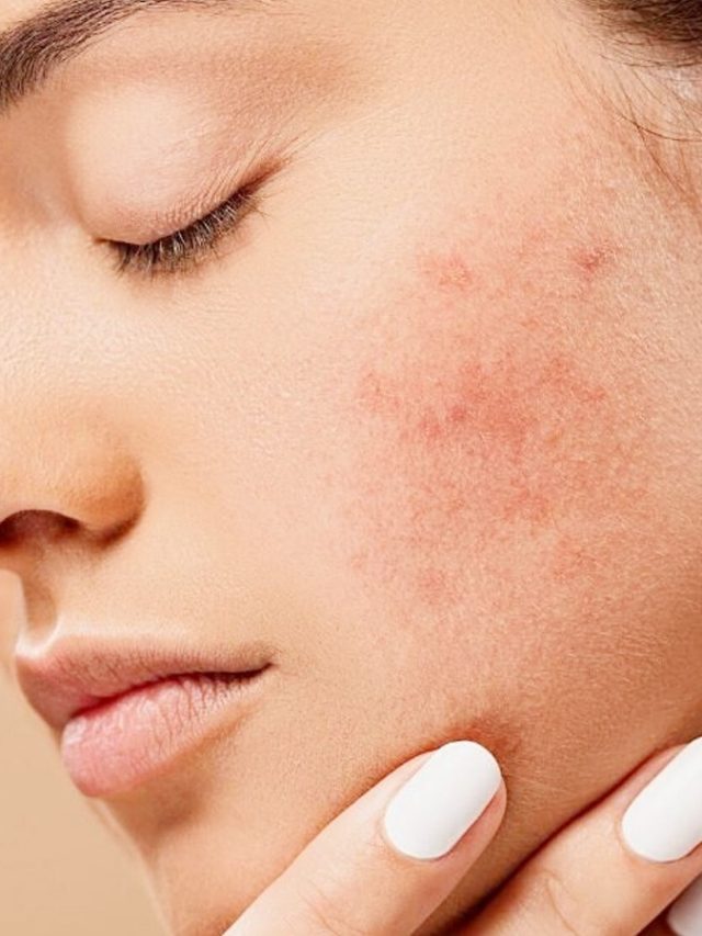 Top 10 Home Remedies For Face Pimples And Marks