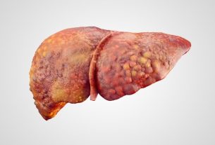 Treatment for liver cirrhosis: diet, remedies and natural options