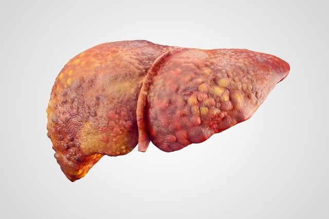 Treatment for liver cirrhosis: diet, remedies and natural options