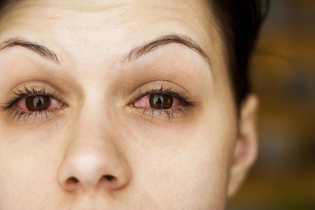 Types of conjunctivitis: bacterial, viral or allergic (and how to confirm)