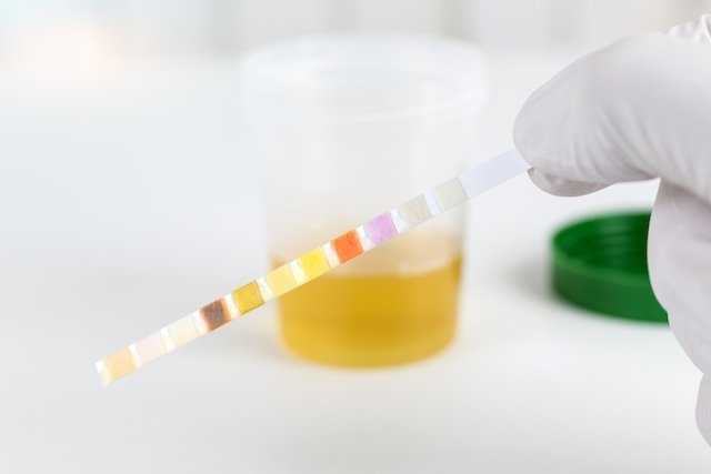 Urine test (EAS): what it is for, preparation and results