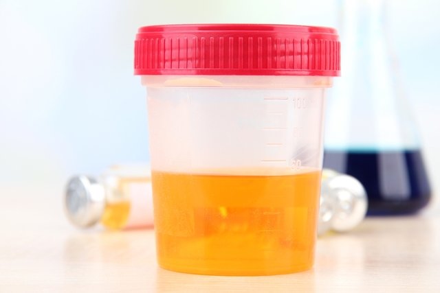 Urobilinogen in urine: what it can be and what to do