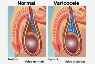 Varicocele: what it is, symptoms, causes and treatment