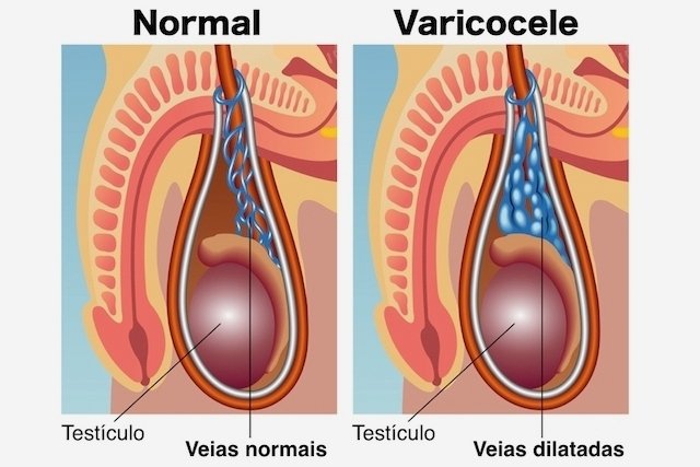 Varicocele: what it is, symptoms, causes and treatment