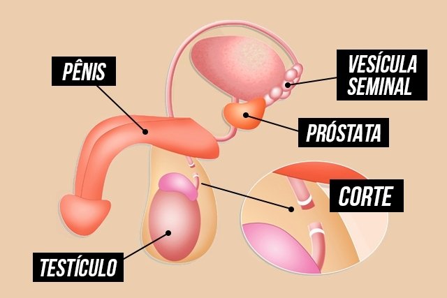 Vasectomy: what it is, how it is done and other common questions