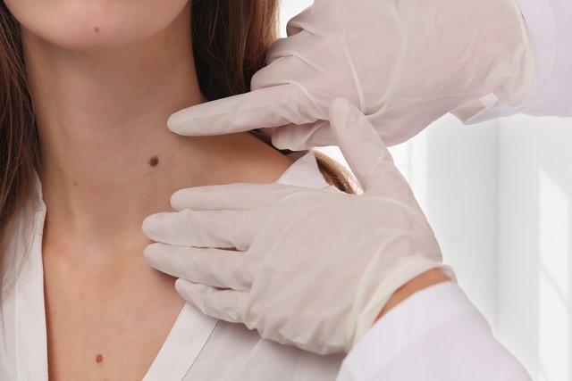 Warts on the neck: what they could be (and what to do)