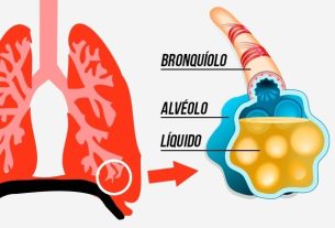 Water in the lung: what it is, symptoms, causes and treatment