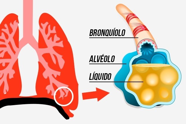 Water in the lung: what it is, symptoms, causes and treatment