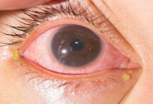 What are the symptoms and how to treat Trachoma