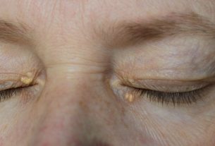 Xanthelasma: what it is, causes and treatment