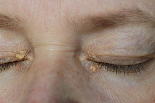 Xanthelasma: what it is, causes and treatment