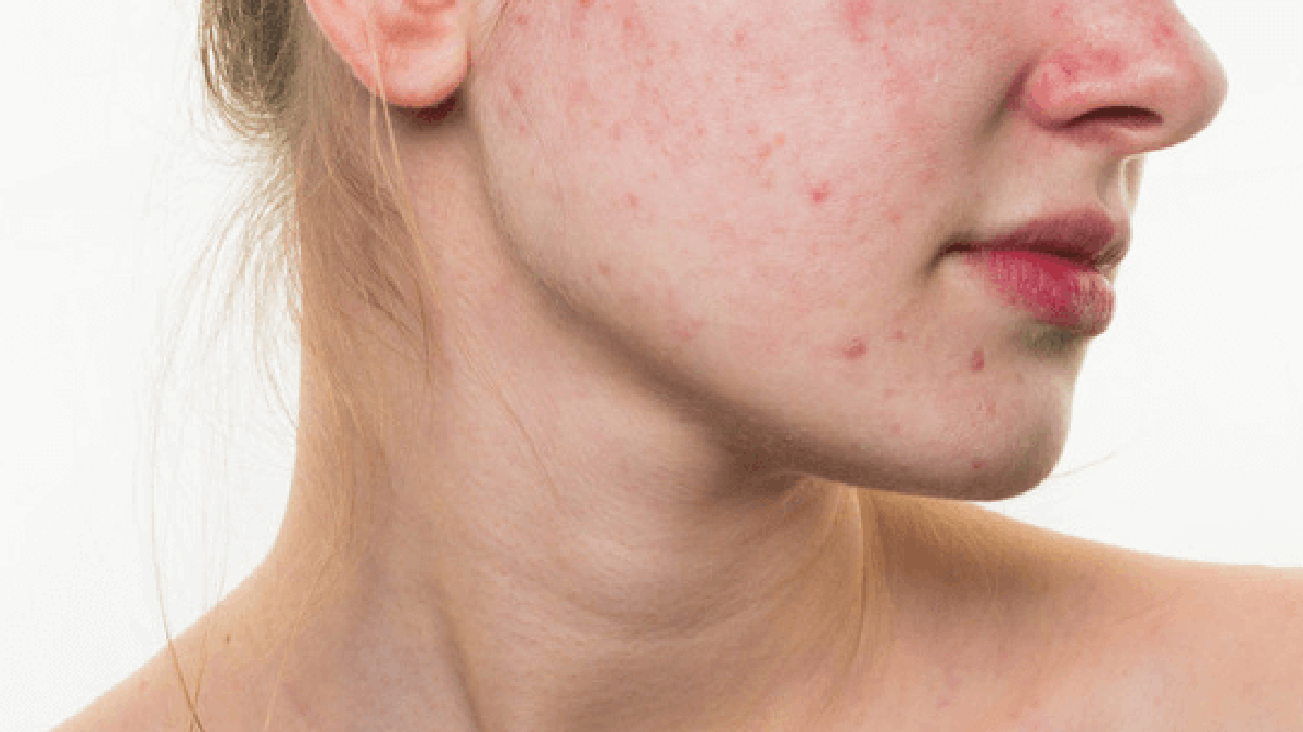 10 recipes to dry pimples at home