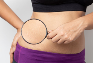 5 simple tricks to hide cellulite and stretch marks