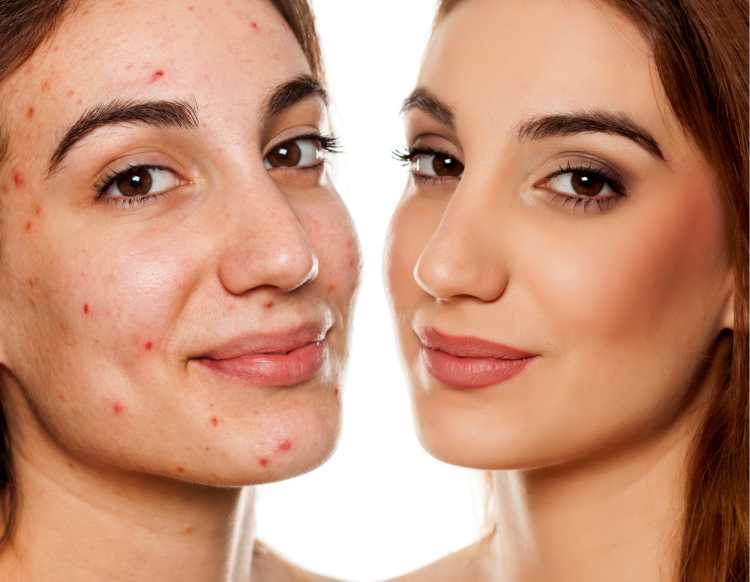 makeup to hide acne spots