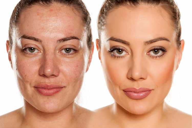 makeup to hide blemishes on your face before and after