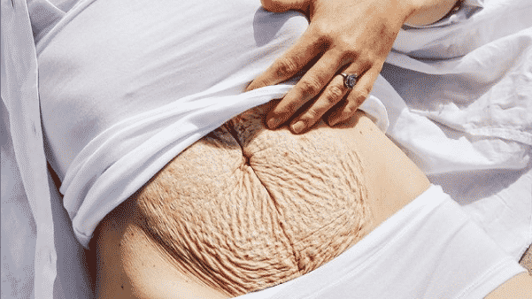 What is abdominal diastasis, which affected a blogger from Denmark