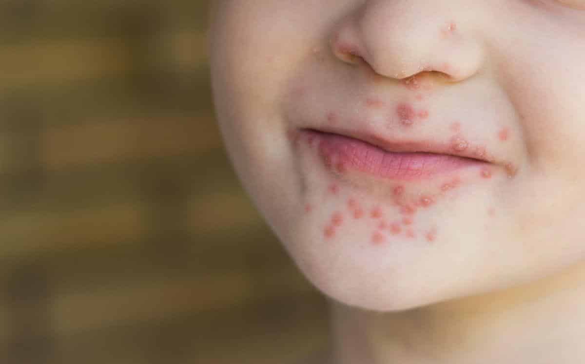 Hand-foot-and-mouth disease: causes, symptoms, care and treatments