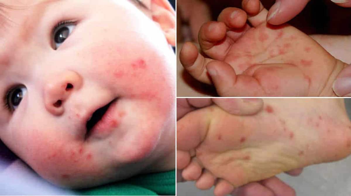 Hand-foot-and-mouth disease: causes, symptoms, care and treatments