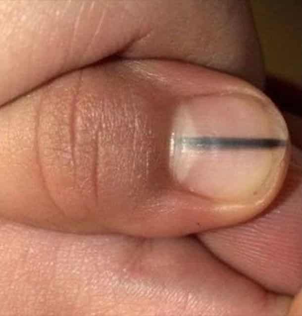 12 changes and marks on your nails that indicate illnesses (besides Covid)