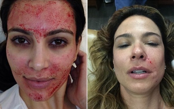 Kim Kardashian beauty treatments